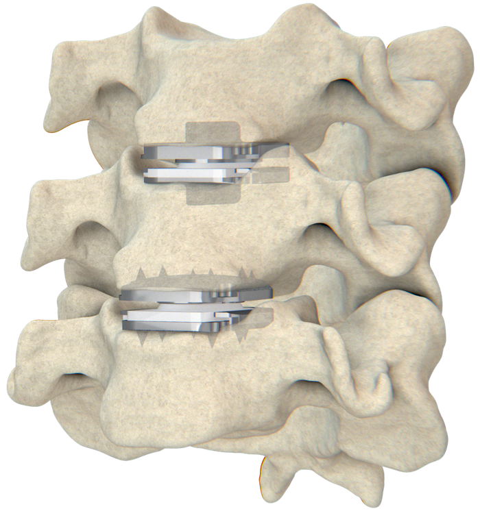 Two prodisc cervical discs implanted at adjacent levels on a spine model